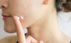 The best creams against acne 15